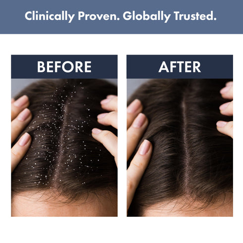 Thriveco in Anti dandruff kit Scalp Clear Shampoo Anti Dandruff Serum