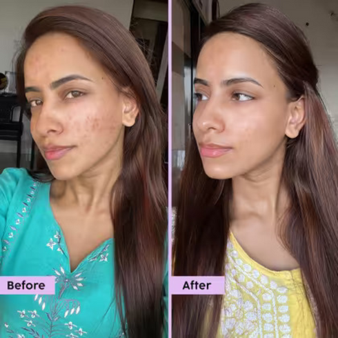 Moraze Cosmetics Skin Reborn 1 Acne Controlling Serum Free Lip Scrub