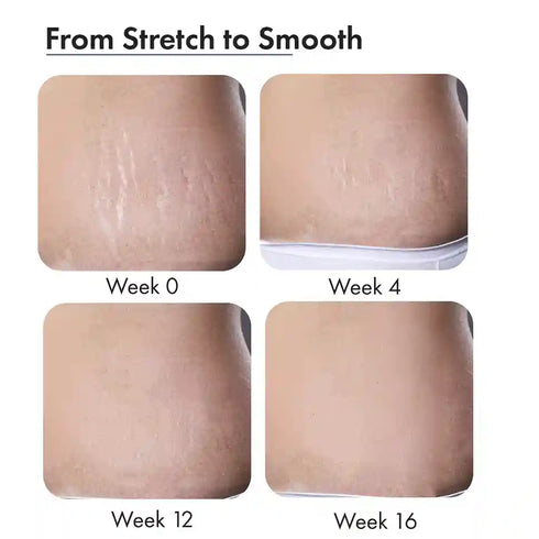 Thriveco Stretch Marks Expert Serum Cream