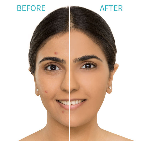 Nykaa Skin Secrets Tea Tree & Salicylic Acid Spot Patch