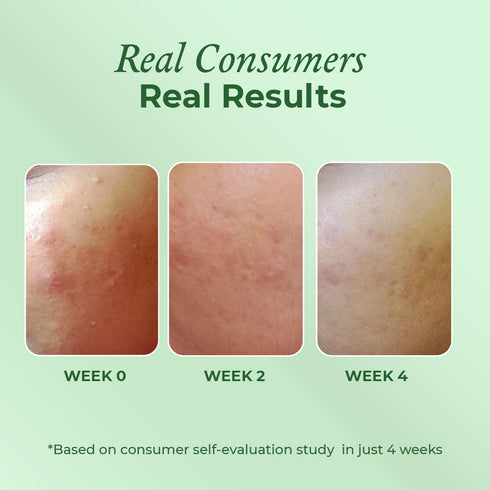 The Pink Foundry Acne Care & Healing Gel Moisturiser