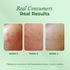 The Pink Foundry Acne Care & Healing Gel Moisturiser