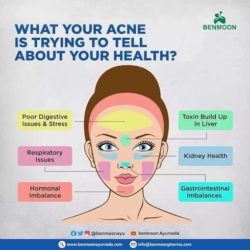 Benmoon Ayurveda Acnova Gel