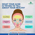 Benmoon Ayurveda Acnova Gel