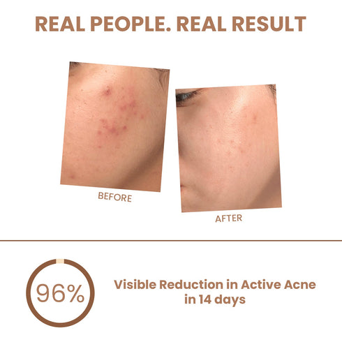 The Skin Stroy Pimple & Acne Corrector Gel