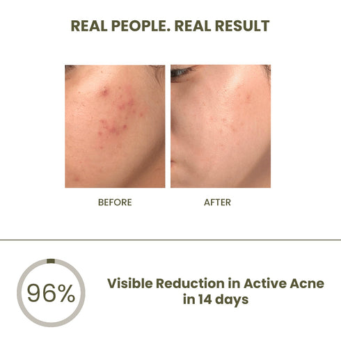 The Skin Story Anti-Acne & Pimple Set