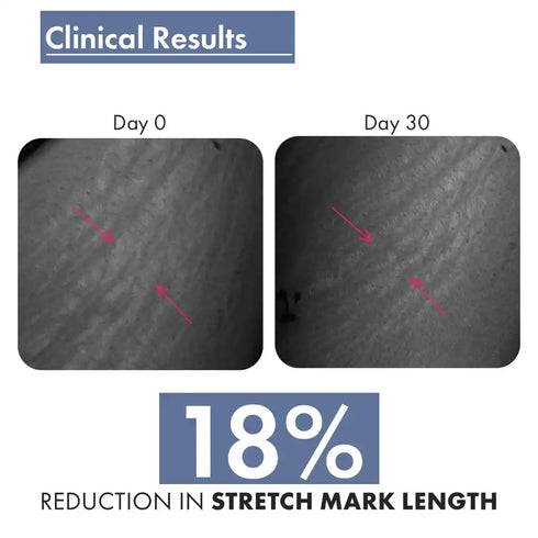 Thriveco Stretch Marks Expert Serum Cream