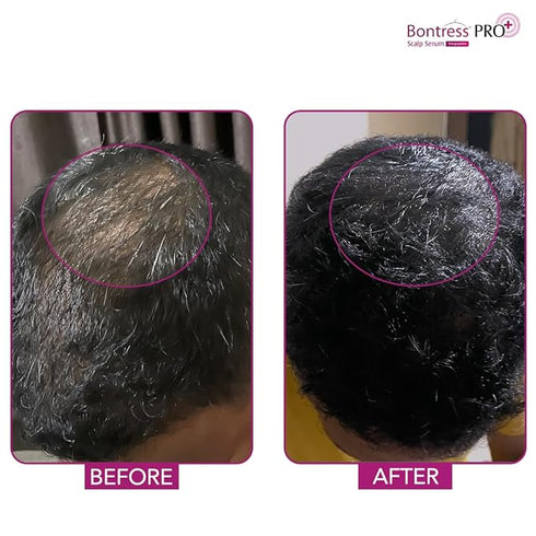 Bontress PRO+ Scalp Serum Fortified