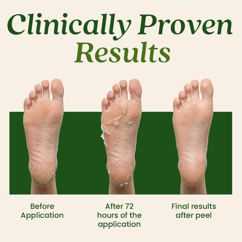 WildGlow Korean Peeling Foot Mask for Dry Cracked Feet