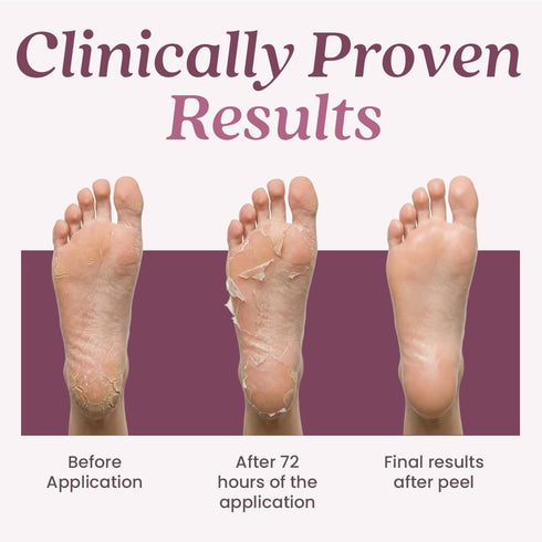 WildGlow Korean Peeling Foot Mask for Dry Cracked Feet