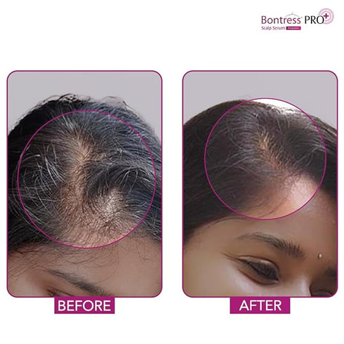 Bontress PRO+ Scalp Serum Fortified