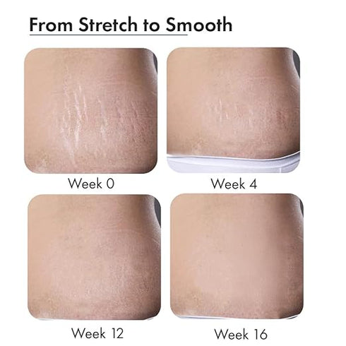 ThriveCo Stretch Marks Expert Serum Cream 30ml