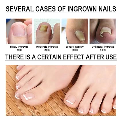 Ruesy Ingrown Toenail Softening And Care Drops Nail Softener And Foot Hygiene Solution