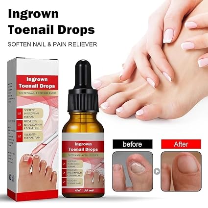 Ruesy Ingrown Toenail Softening And Care Drops Nail Softener And Foot Hygiene Solution
