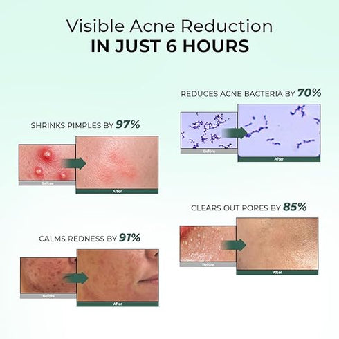 Conscious Chemist Rapid Relief Acne Spot Corrector Gel