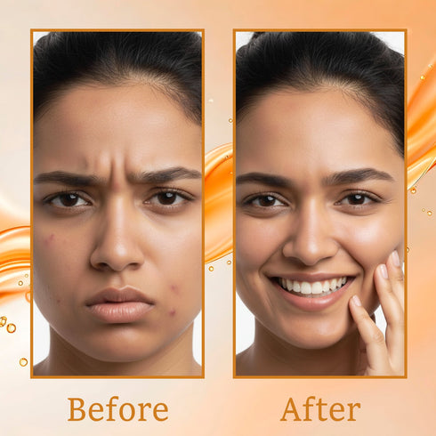 Karrot Salicylic Anti Acne Serum