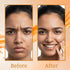 Karrot Anti Acne Range