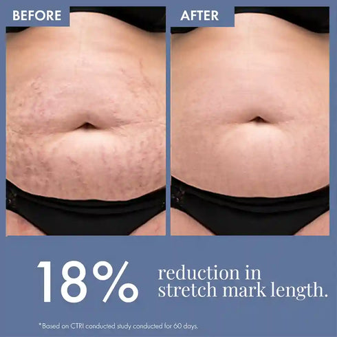Thriveco Stretch Marks Expert Serum Cream