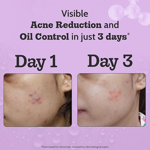 Innovist Acne Control Face Serum