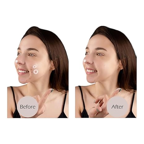 ROYAL NEEDS Acne Pimple Patch - Invisible Facial Stickers