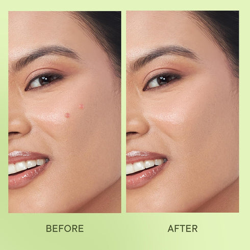 Quench Zit Away Acne Pimple Patches