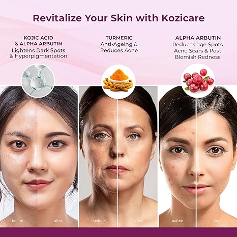 Kozicare Kojic Acid Face Cream with Turmeric for Summer Daily Use
