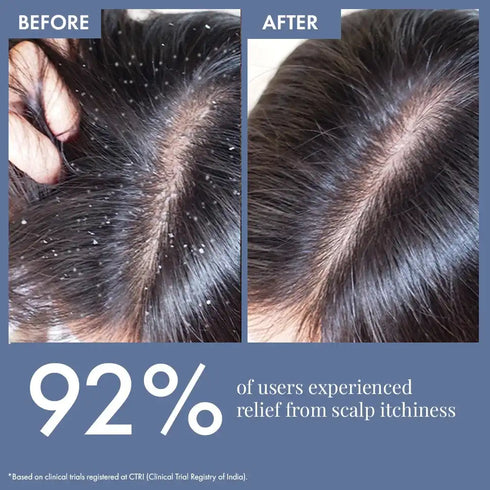 Thriveco Anti Dandruff Serum