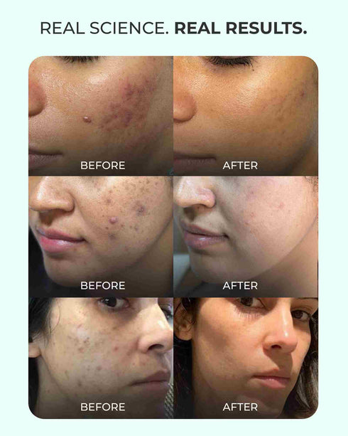 Aqueria Anti Acne Oil Control French Multi Active Serum