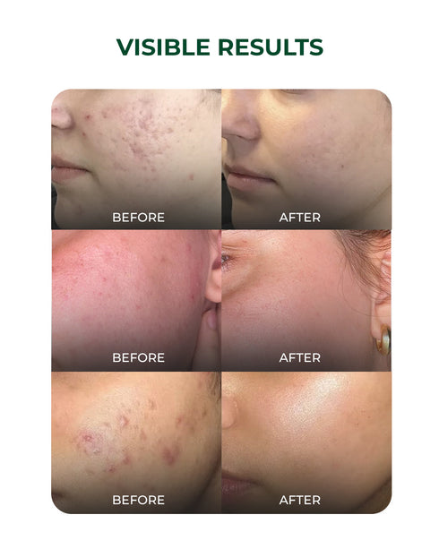 Aqueria Multi Active Discovery Kit for Acne Control Oil Balance and Breakout Prevention