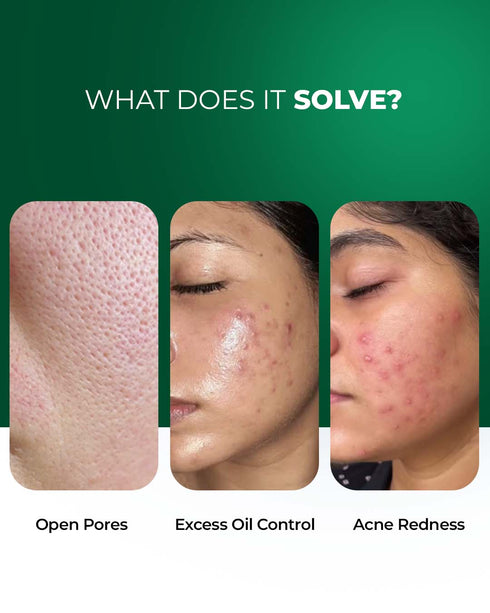 Aqueria Anti Acne Oil Control French Multi Active Serum