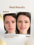 Flawora's Anti Acne Serum
