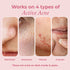 The Pink Foundry Acne Fighting Duo