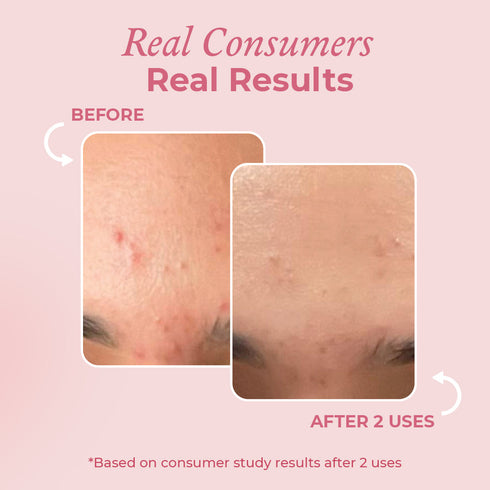 The Pink Foundry Acne Treatment Combo