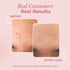 The Pink Foundry Acne Treatment Combo