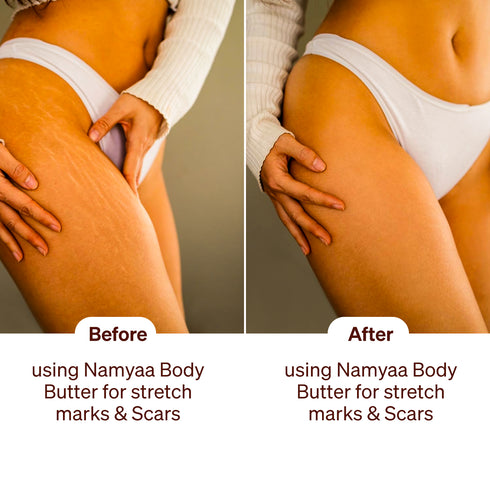Namyaa Skincare Body Butter for Stretch Marks & Scars
