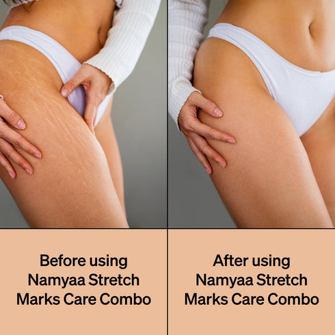 Namyaa Skincare Stretch Marks Care Combo