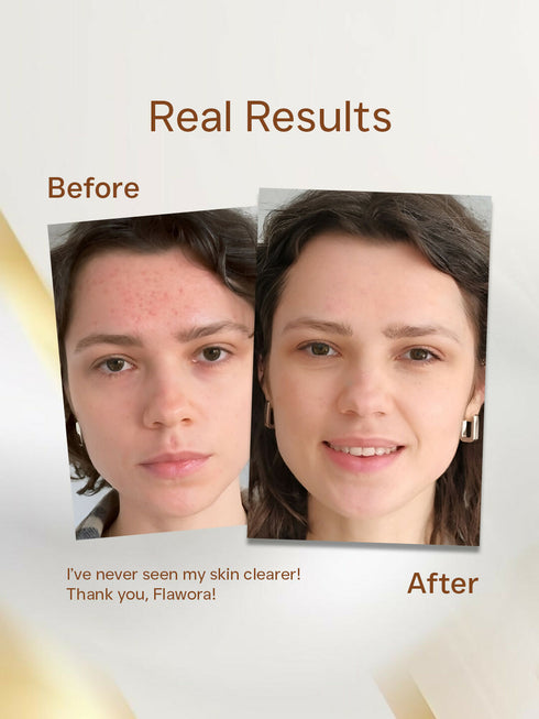 Flawora Anti-Grey Hair Serum For Reversing Grey Hair and Anti Acne Serum to reduce Blackheads and Open Pores