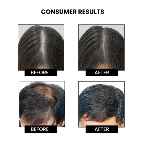 Thriveco Dandruff Treatment Trial kit