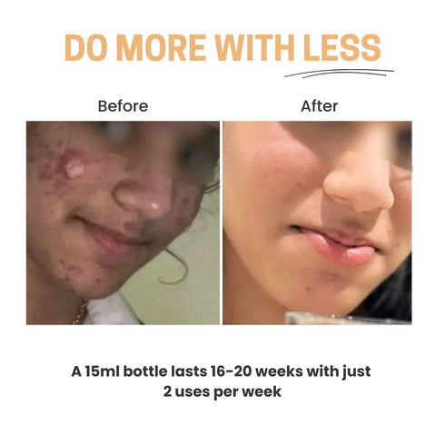 Chosen Light Routine Easy Salicylic Acid Peel