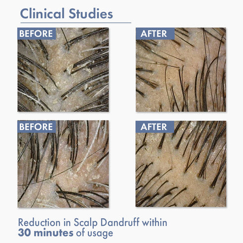 Thriveco Dandruff Treatment Trial kit