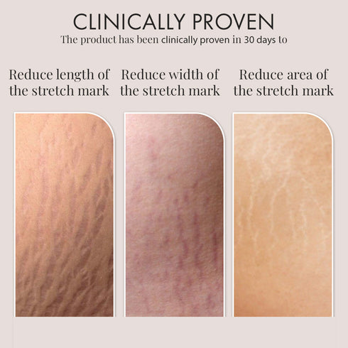 Thriveco Stretch Marks Trial Kit