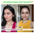 Jamun Acne Spot Corrector Gel For Active Acne