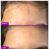 Jamun Acne Spot Corrector Gel For Active Acne