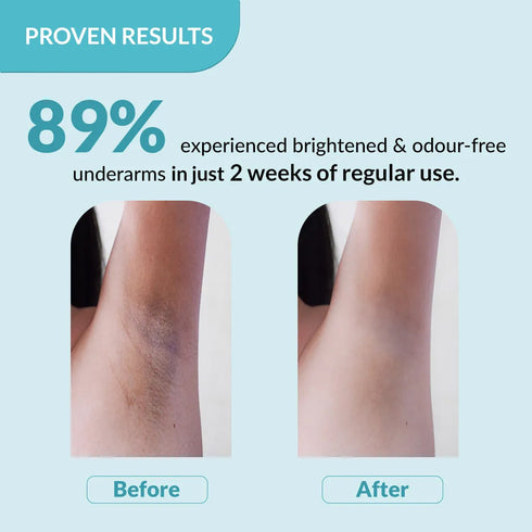 FixDerma Nigrifix Underarm Lightening Roll On | 6% AHA to Reduce Underarm Pigmentation in 2 Weeks