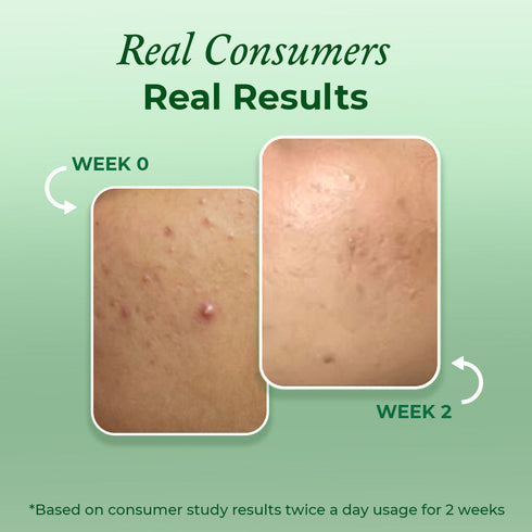 The Pink Foundry Clearing & Calming Acne Face Wash
