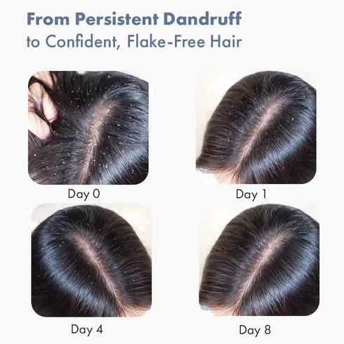 Thriveco Anti Dandruff Serum