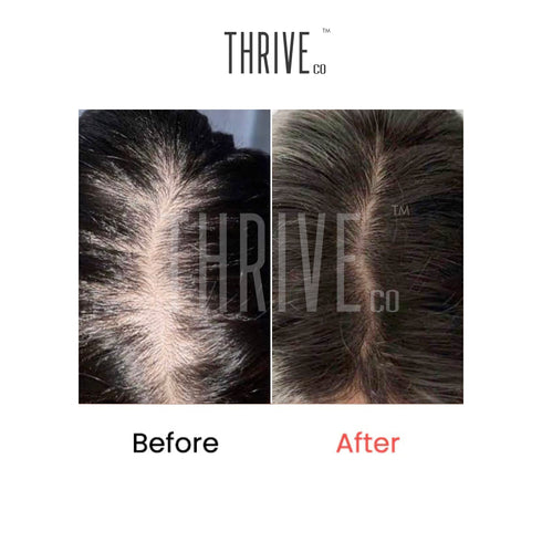 Thriveco Hair Care Kit ThriveCo Scalp Scrub Vitalizing Serum Hair Growth Serum