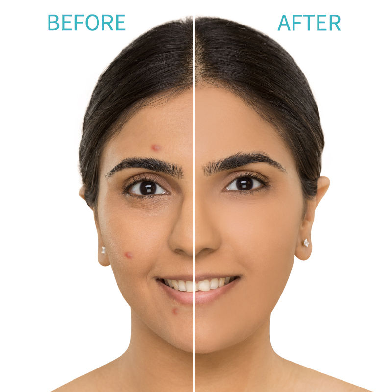Nykaa Skin Secrets Tea Tree & Salicylic Acid Spot Patch - PUSHMYCART