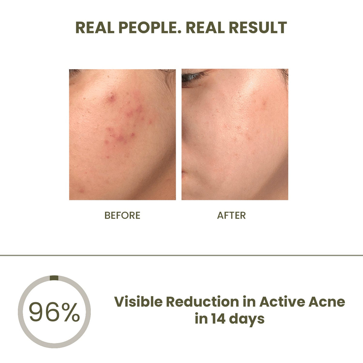 The Skin Story Anti-Acne & Pimple Set