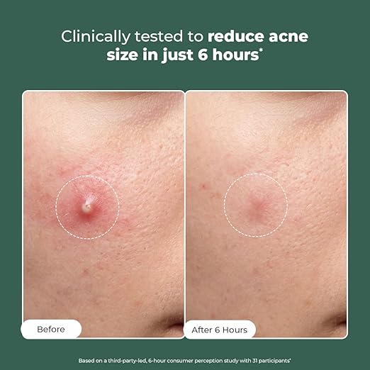 Conscious Chemist® Rapid Relief Acne Spot Corrector Gel